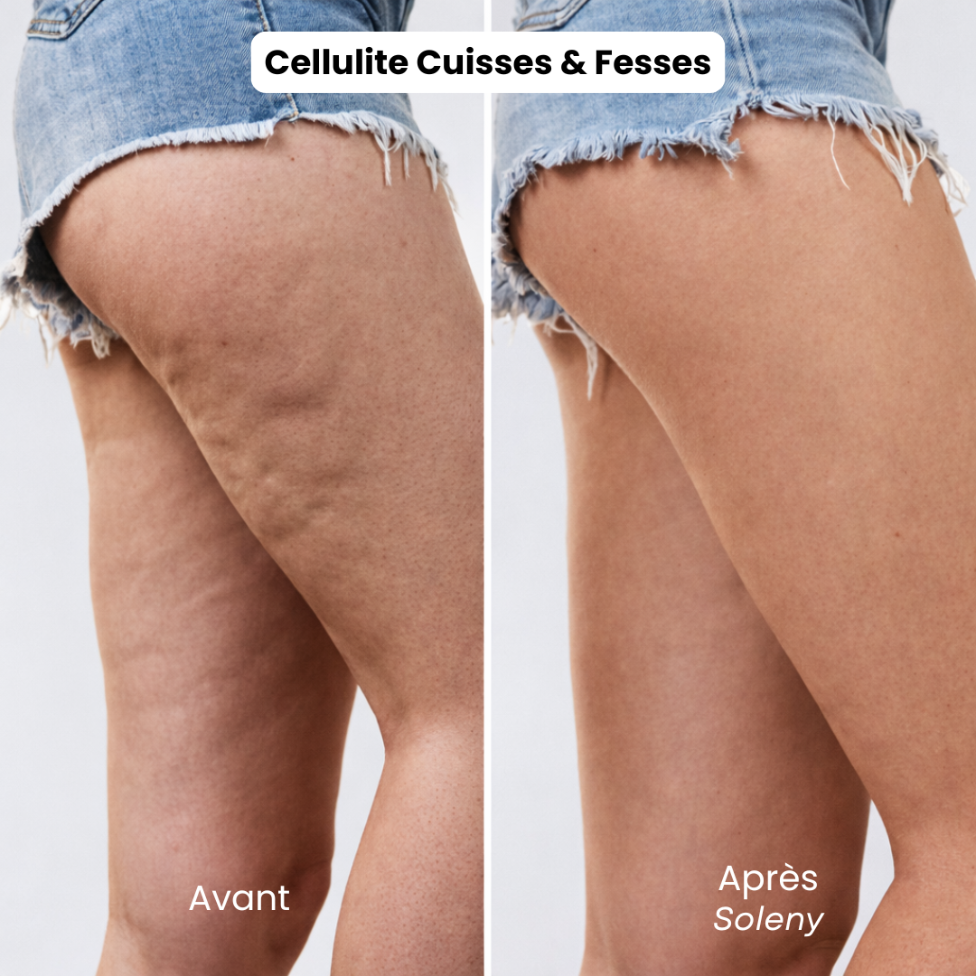 Soleny FitSkin+ | Lisse, raffermit, sculpte. Rapidement.