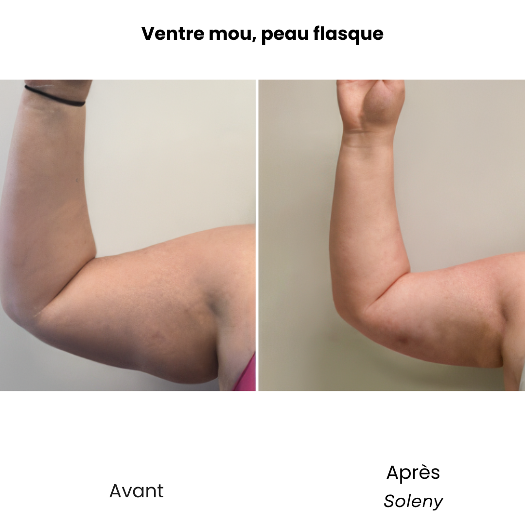 Soleny FitSkin+ | Lisse, raffermit, sculpte. Rapidement.